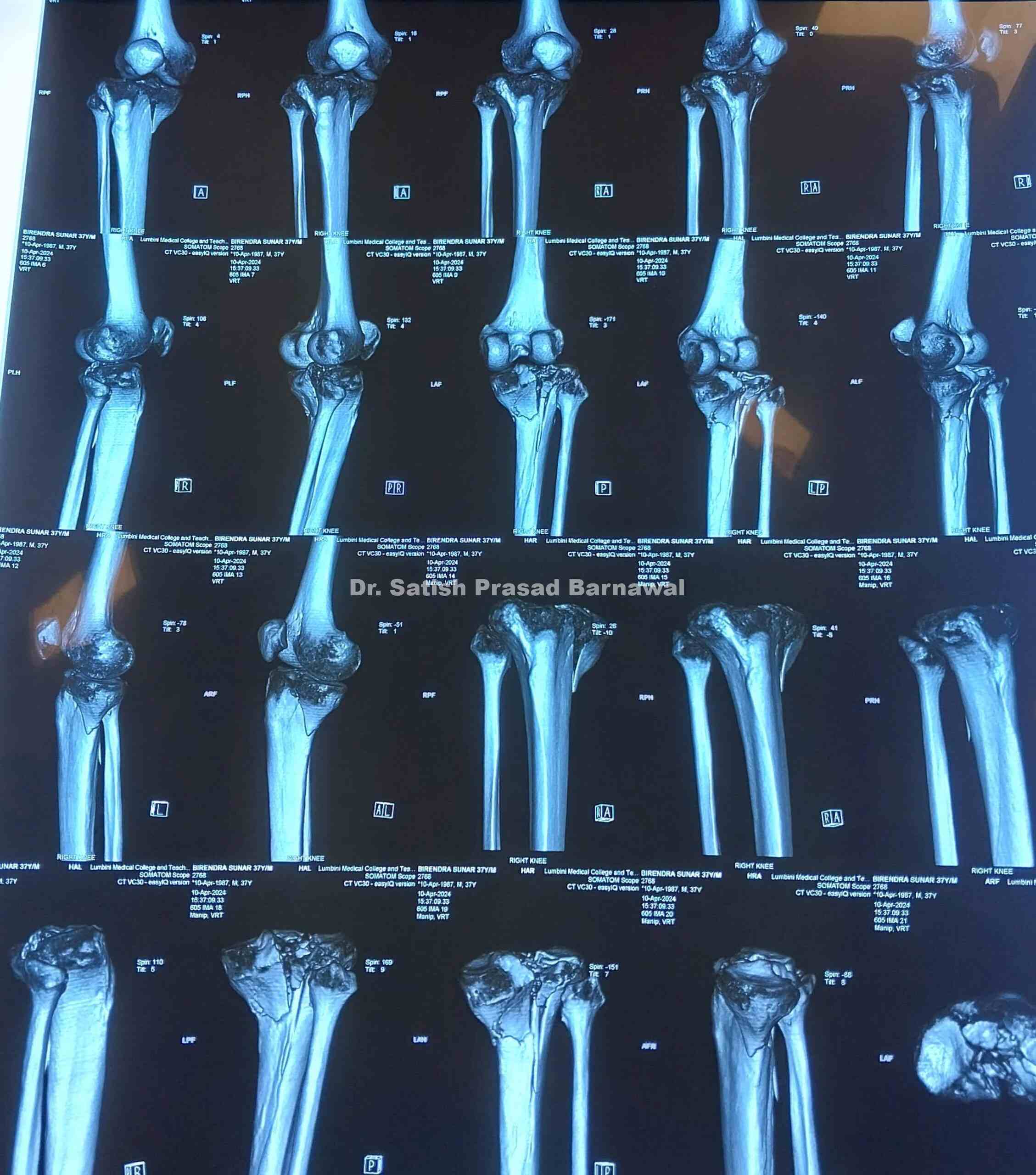 Tibia Scan Case 2: Tibial Plateau Fracture Plating - Dr. Satish Prasad Barnawal