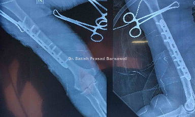 Case 1: Humerus Fracture Plating