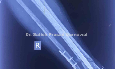 Case 1: Distal Third Tibia and Fibula Fracture Treated with Xpert Nail and Plate