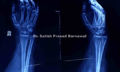 Case 2: Open Radius & Ulna Fracture Treated with