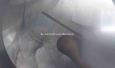 Case 3: Same Side Intertrochanteric and Shaft of Femur Fracture PFN Fixation