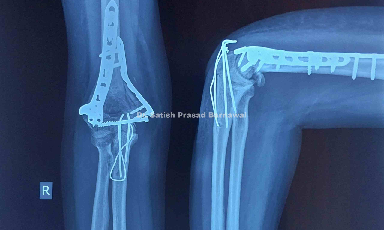 Case 1: Distal Humerus Fracture with Intra-articular Extension Bicolumnar Plating