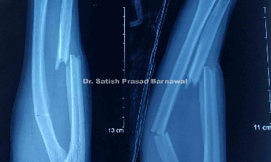 Case 1: Proximal Third Radius Fracture and Middle Third Ulna Fracture Plating