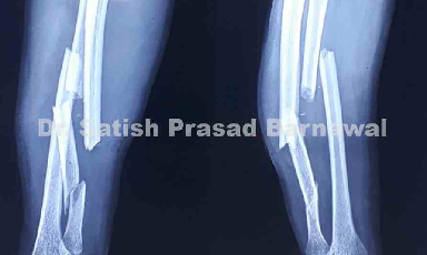 Case 2: Radius and Multifragmentary Ulna Fracture Plating