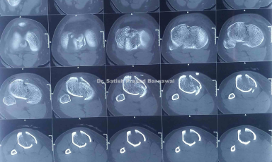 Case 1: Tibial Plateau Fracture Bicolumnar Plating