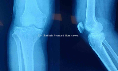 Case 2: Tibial Plateau Fracture Plating