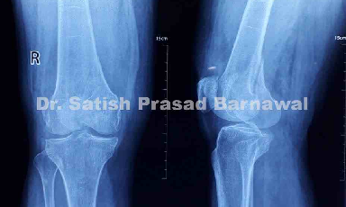 Case 3: Medial Condyle Femur Fracture Plating on Medial Side