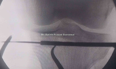 Case 4: Non Displaced Tibial Plateau Fracture Screw Fixation