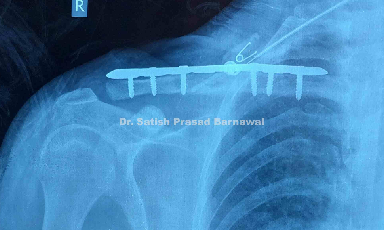 Case 2: Clavicle Fracture