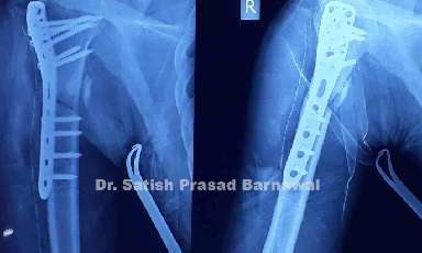 Case 1: Proximal Humerus Fracture