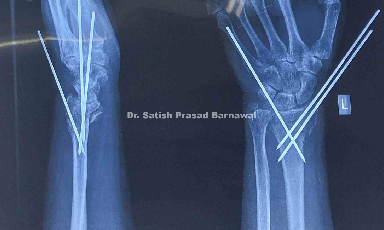 Case 1: Multi-fragmentary Distal Radius Fracture Pinning