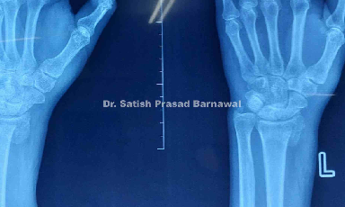 Case 2: Volar Barton Distal Radius Radius Fracture Plating