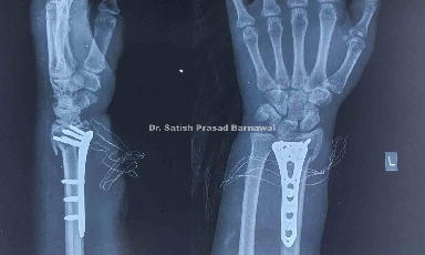 Case 3: Intra-articular Distal Radius Fracture Plating
