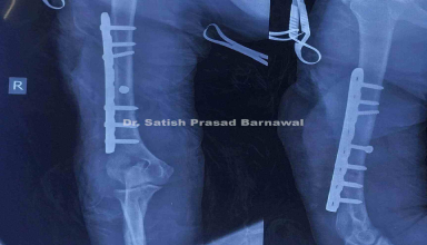 Case 2: Humerus Fracture Plating and Successful Removal