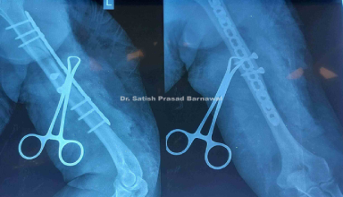 Case 3: Humerus Fracture Plating