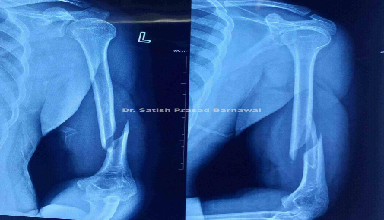 Case 4: Distal Third Humerus Fracture Plating