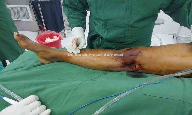 Case 3: Degloving Injury Lower Limb Treated with Skin Graft