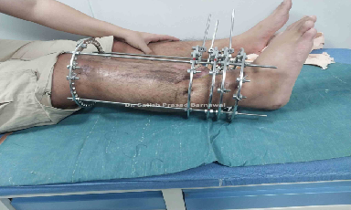 Case 4: Ilizarov Application in Tibia Fracture with Bone Loss of More than 15 Centimeter