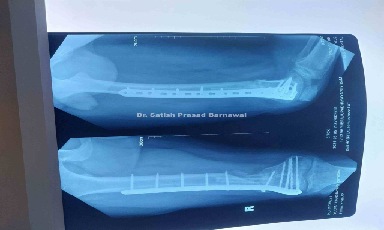 Case 5:  Open Distal Femur Fracture with Bone Loss Treated with Plating and Bone Graft