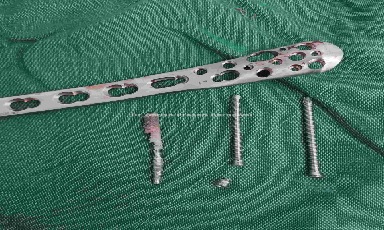 Case 1: 8 Years Old United Tibia Fibula Fracture with Locking Plate in Situ