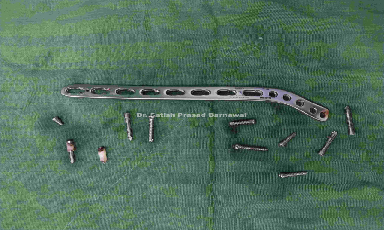 Case 2: United Humerus Fracture with Locking Plate in Situ