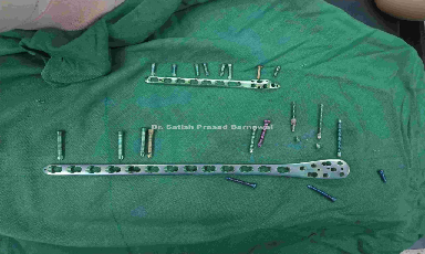 Case 3: United Distal Tibia Fibula Fracture with Titanium Plate in Situ