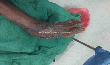 Case 1: Degloving Injury Ankle with Infection Treated with Skin Graft