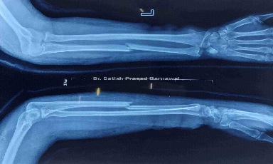 Case 2: Degloving Injury Forearm Treated with Skin Graft