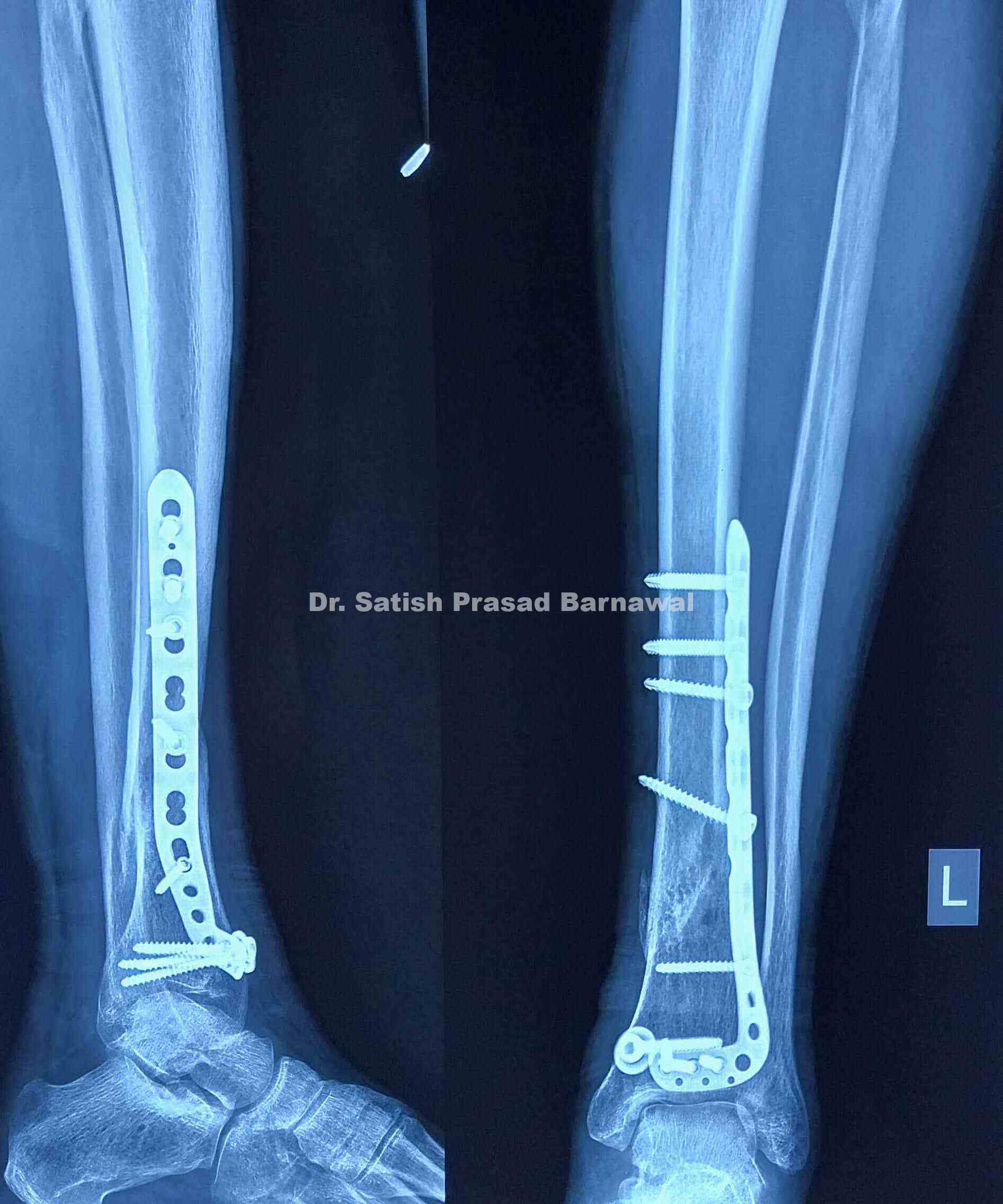 Third Tibia Case 7: Distal Third Tibia Fracture Treated with Anterolateral Plating ...