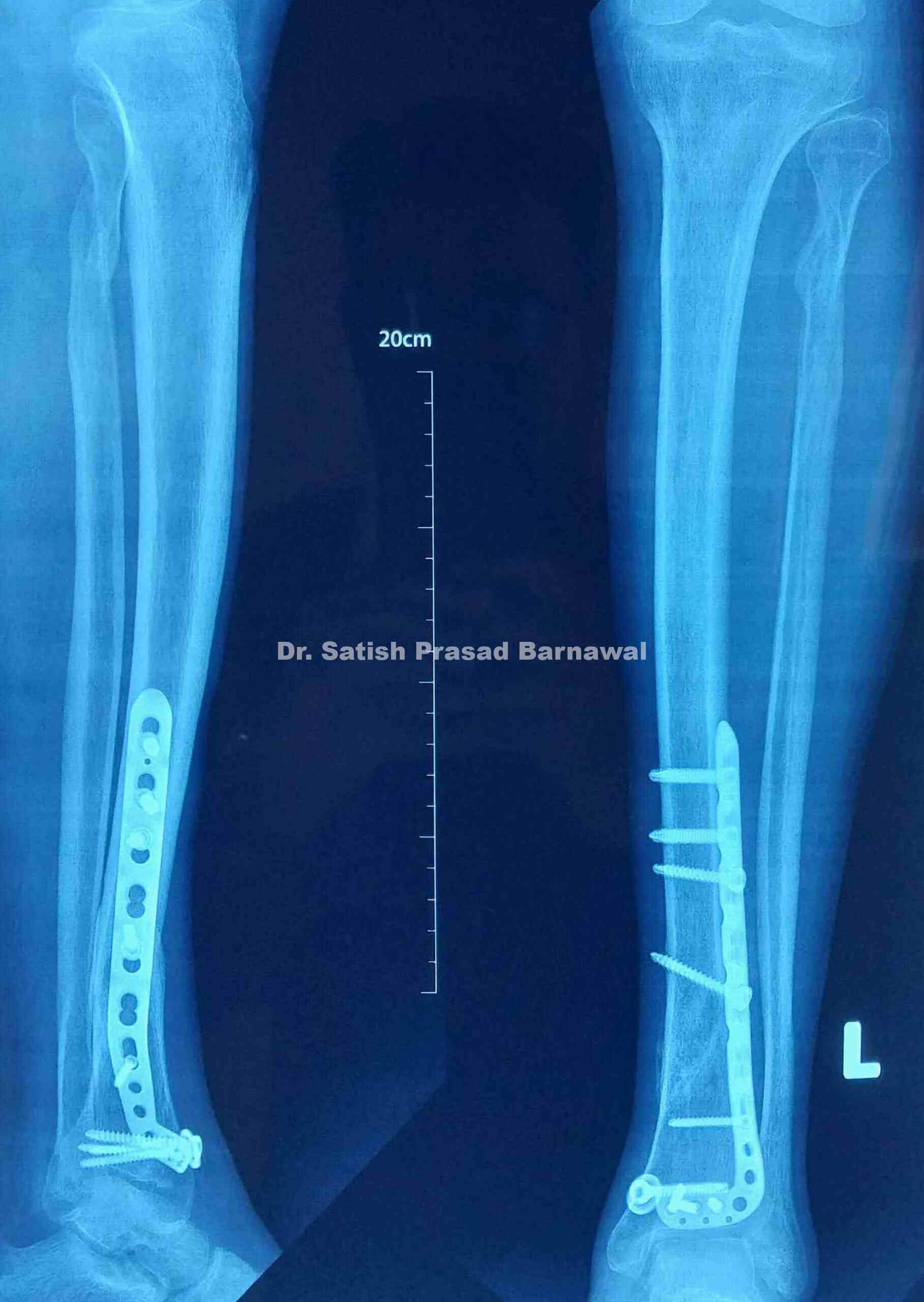 Third Tibia Case 7: Distal Third Tibia Fracture Treated with Anterolateral Plating ...