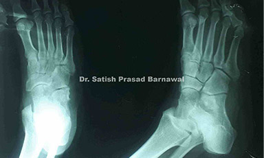 Case 4: Open Talus Fracture Treated with  Herbert Screw Fixation and External Fixator Followed by Wound Care