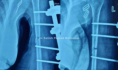Case 5: Open Humerus Fracture with Staged Treatment