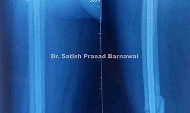 Case 3: Non-Union Distal Third Shaft of Femur Fracture with Broken Plate Treated with Implant Removal, Nailing and Bone Grafting