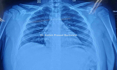 Case 7: Proximal Humerus Physeal Injury in a Child Treated with Closed Reduction and Pinning