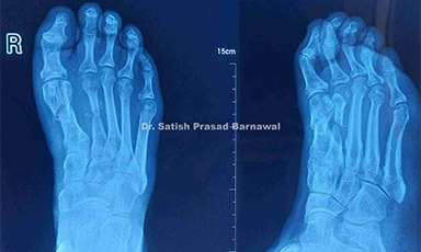 Case 1: Machinery Injury Foot Treated with Debridement, Irrigation, Exploration, Pining and Tendon Repair