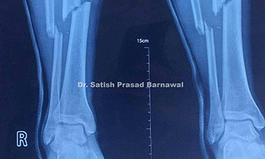 Case 1: Proximal to Middle Third Tibia Fracture Treated with Minimal Invasive Plating
