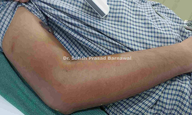Case 1: Septic Arthritis Right Elbow