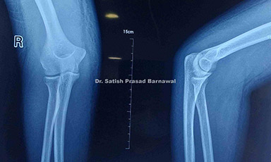 Case 3: Septic Arthritis of Elbow
