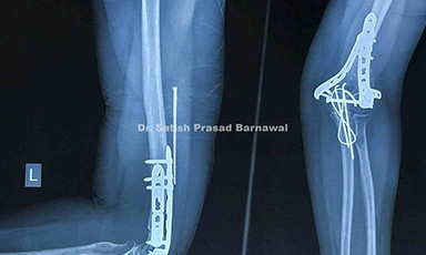Case 2: Distal Humerus Fracture with Intra-articular Extension Treated with Bicolumnar Plating