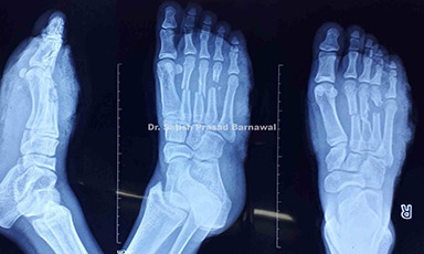 Case 2: Multiple Open Metatarsal Fracture with Raw Area Treated with Pinning, Serial Debridement, Irrigation and Skin Graft