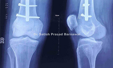 Case 2: Implant Failure, Bent Nail, of Femur Fracture Treated with Implant Removal and Re-fixation with Nailing