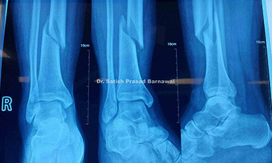 Case 2: Union of Distal Third Tibia Fracture Treated with Closed Reduction and Nailing