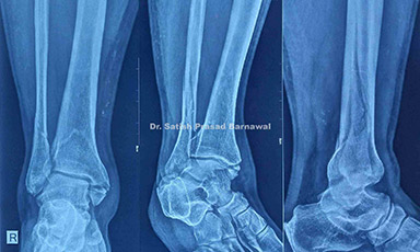 Case 3: Trimalleolar Fracture Treated with Open Reduction and Internal Fixation of All Three Components