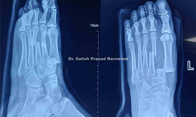 Case 3: Open Lisfranc Fracture Dislocation Managed with Debridement, Irrigation, Pinning and Primary Closure