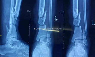 Case 3: Distal Third Multi-fragmentary Open Tibia and Fibula Fracture Treated with Debridement, Irrigation, Exploration and External Fixator Converted to Plating