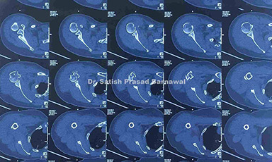 Case 3: Proximal Humerus Fracture Treated with Proximal Humerus Locking Plate