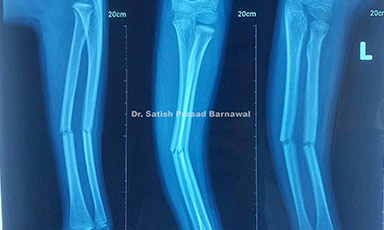 Case 4: Radius and Ulna Fracture in a Child Treated with Closed Reduction and Cast application