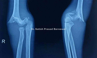 Case 4: Gartland Type IV Suprachondyler Humerus Fracture Treated with Closed Reduction and Pinning