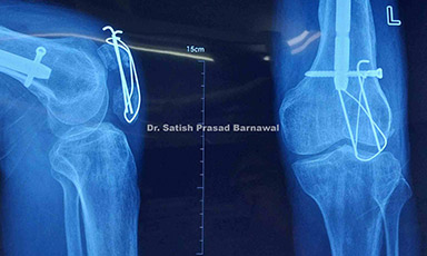Case 4: Re-Fracture of Patella with K-Wires Backout Treated with TBW