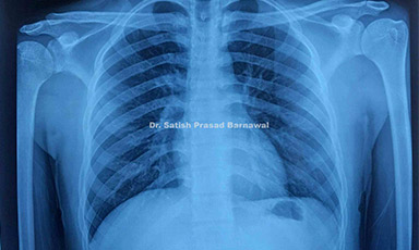 Case 4: AC Joint Disruption Treated with Coracoclavicular Stablization